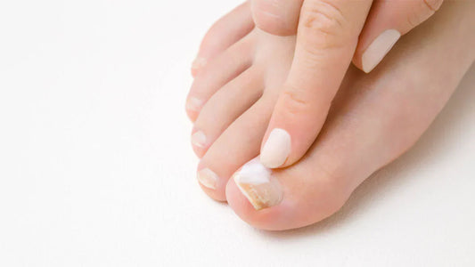 How to Cure Toenail Fungus Naturally