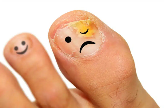 Toenail Fungus Symptoms
