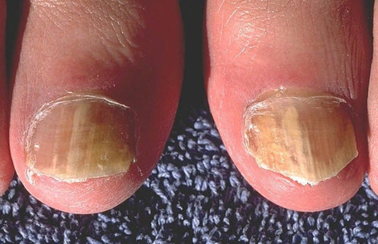 what is toenail fungus