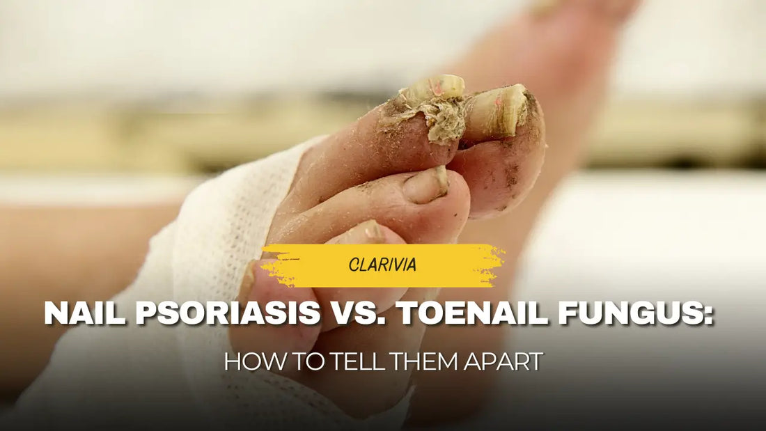 Nail Psoriasis vs Toenail Fungus