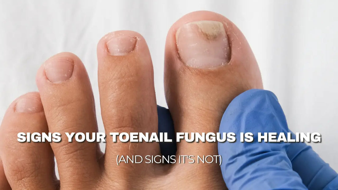 Signs Your Toenail Fungus Is Healing